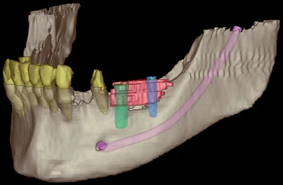 3D-Visualisierung der Implantatplanung