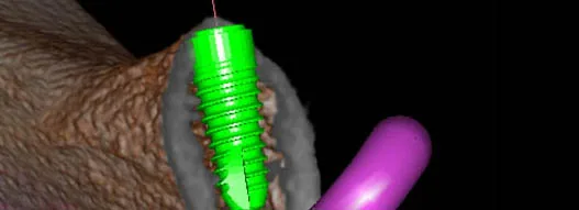 Dreidimensionale, plastische Darstellung unterst&uuml;tzt bei Diagnose, Planung und Insertion der Implantate