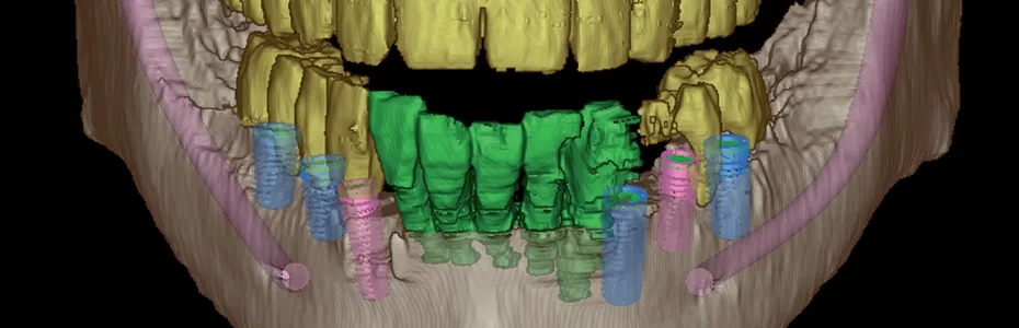 Digitale Volumentomographie: Darstellung der kn&ouml;chernen Strukturen der Kiefer