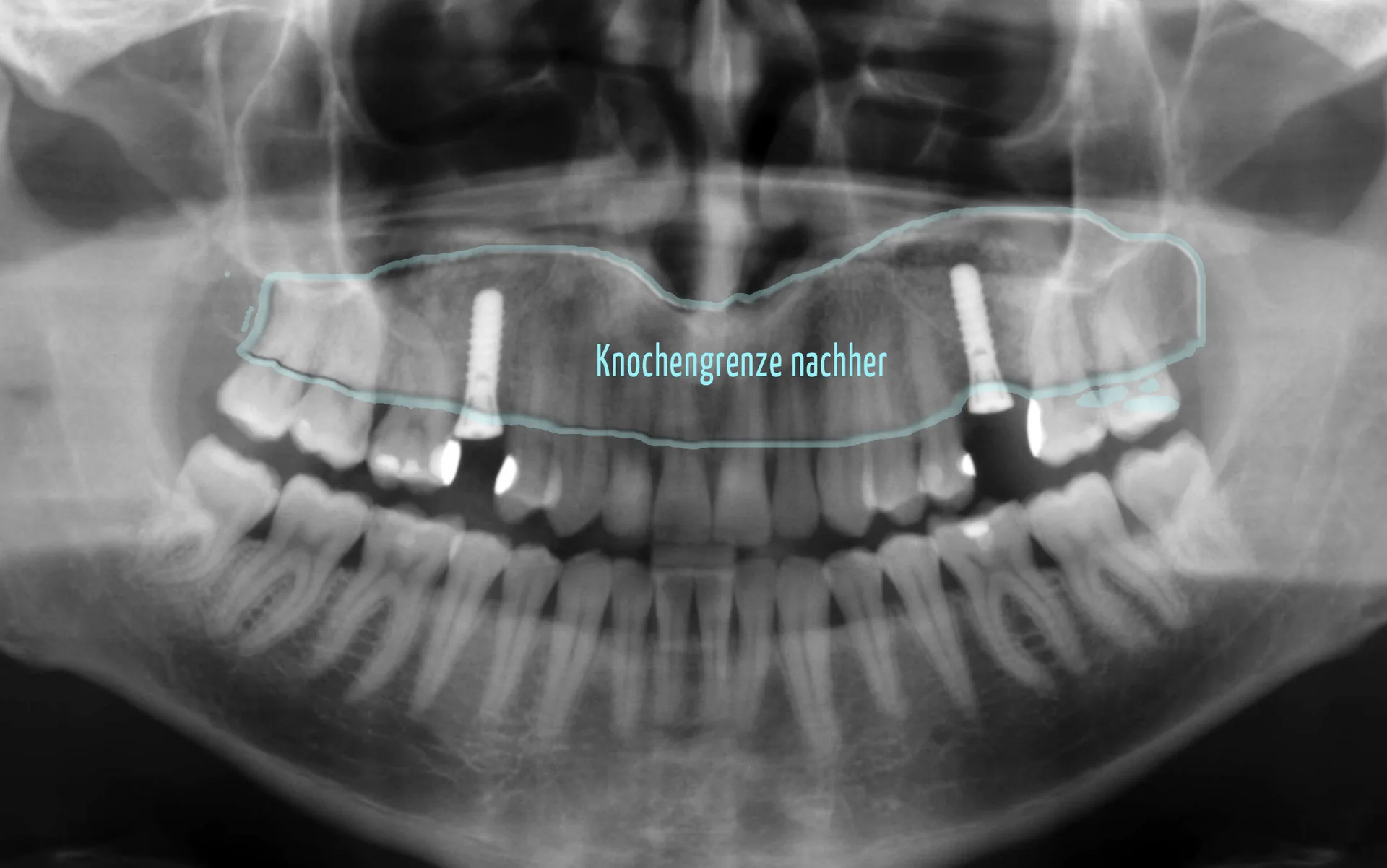 R&ouml;ntgenaufnahme nach erfolgreicher Implantatversorgung