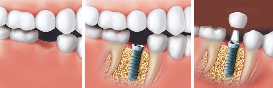 Implantationsverfahren: von der Zahnl&uuml;cke bis zur fertigen Krone