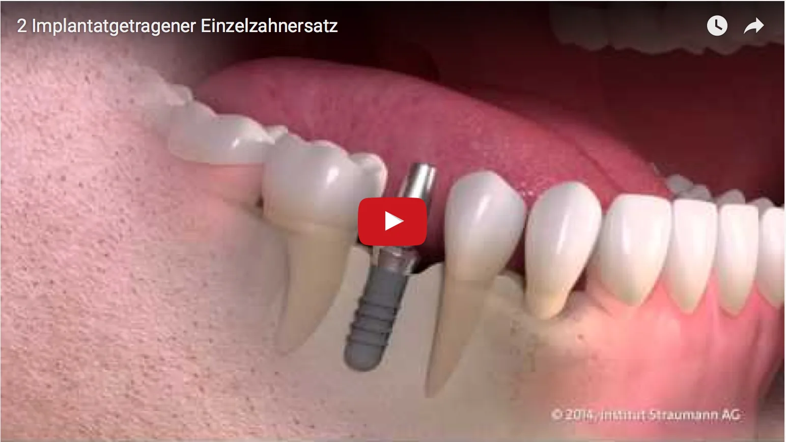Festsitzende, implantatgetragene Z&auml;hne sehen nicht nur aus wie eigene, sondern f&uuml;hlen sich auch so an. Implantat, neuer Zahn und Weichgewebe bilden eine harmonische Einheit.