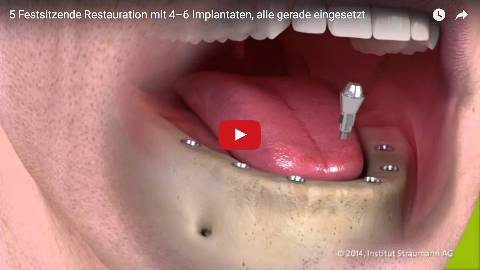 Patienten mit zahnlosem Kiefer haben zwei M&ouml;glichkeiten zur Auswahl: eine auf Implantaten fest verschraubte Zahnreihe oder eine herausnehmbare, implantatgetragene Prothese.