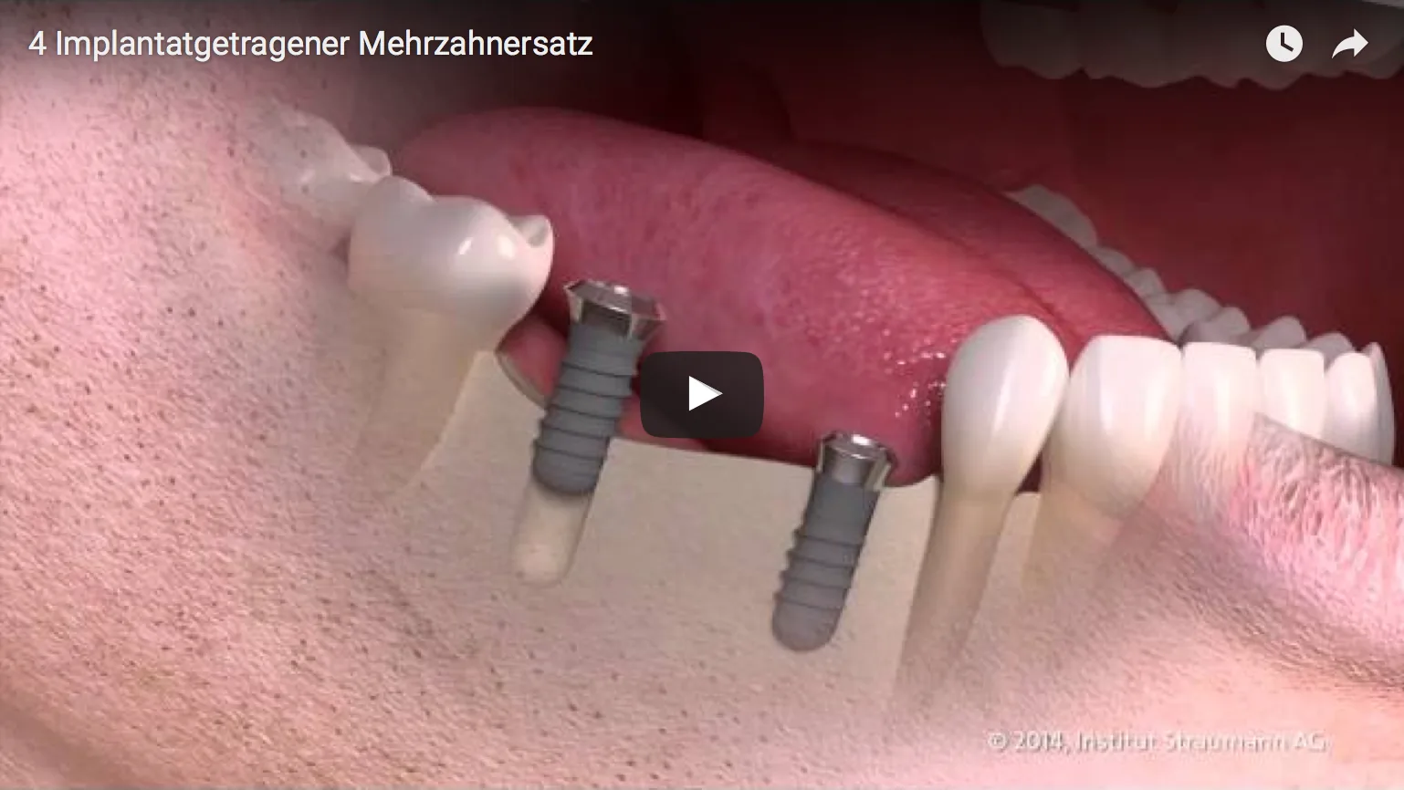 Implantate f&uuml;hlen sich an wie nat&uuml;rliche Z&auml;hne, sitzen fest und f&uuml;gen sich harmonisch in die individuelle Zahnumgebung ein