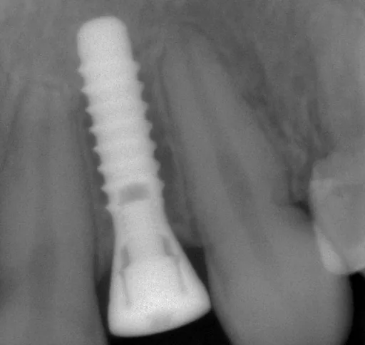 Das Implantat &uuml;bernimmt die Funktion der Zahnwurzel