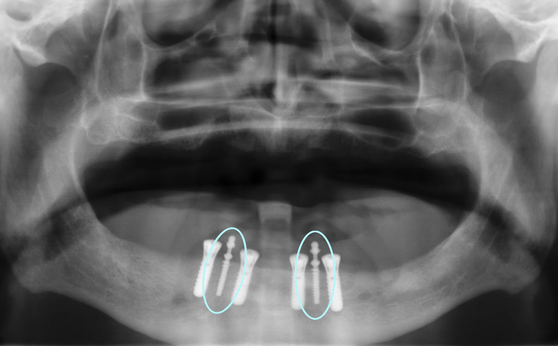 Implantate sorgen f&uuml;r den sicheren Halt der Z&auml;hne