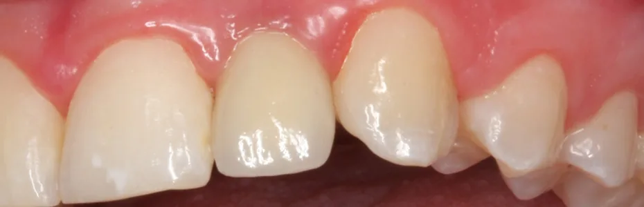 Ergebnis einer Implantatl&ouml;sung in der Praxisklinik f&uuml;r dentale Implantologie & Kieferchirurgie
