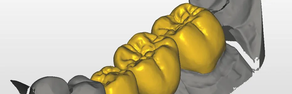 Individuelle CAD-Planung von Kronen
