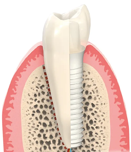 Keramikimplantat Zahn Querschnitt
