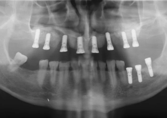 Panorama-R&ouml;ntgen eines komplexen Implantatfalls