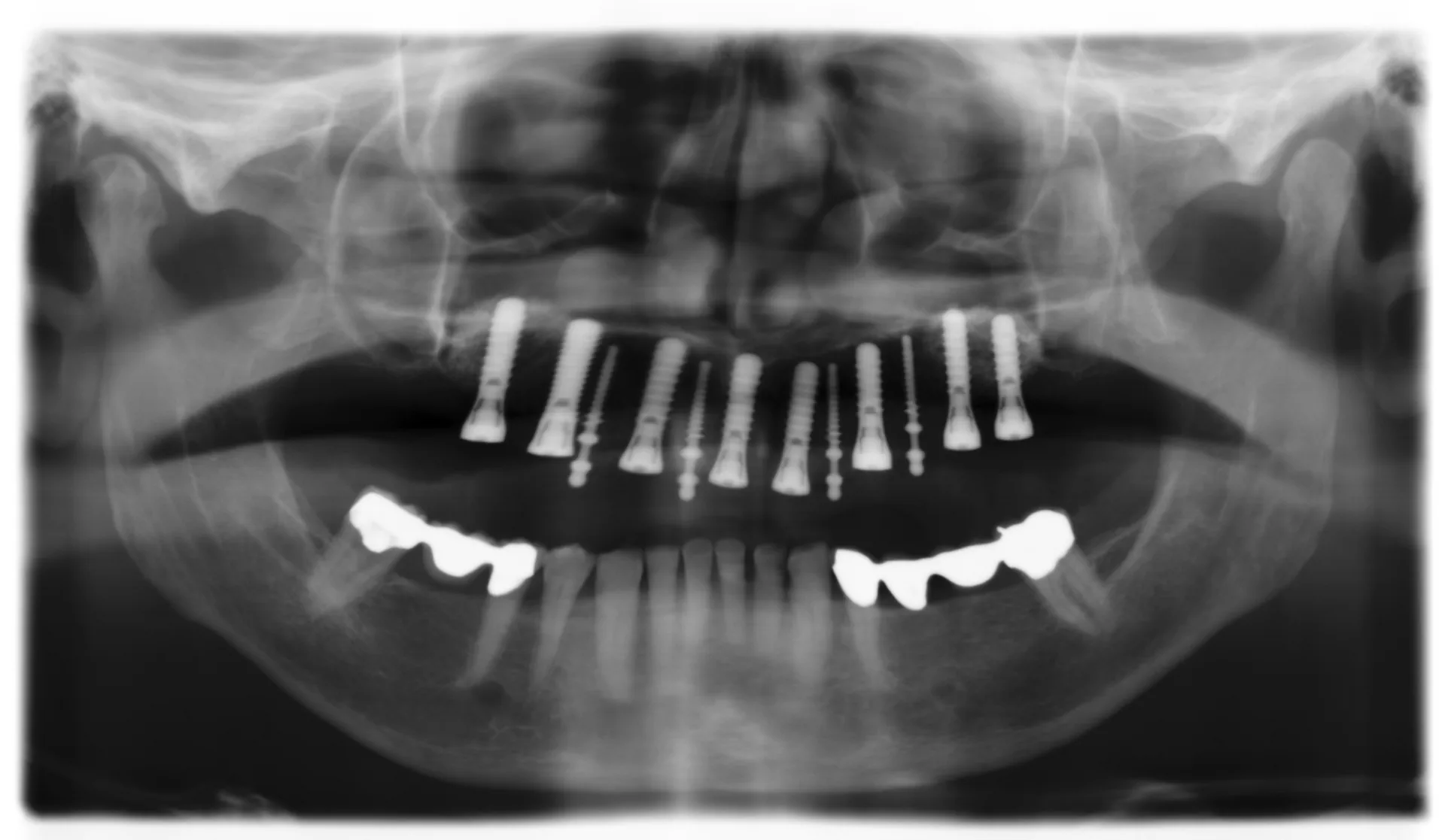 Feste Z&auml;hne mit Implantaten