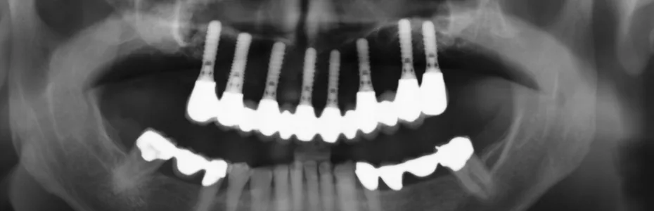 Implantate sorgen f&uuml;r den sicheren Sitz der neuen Z&auml;hne