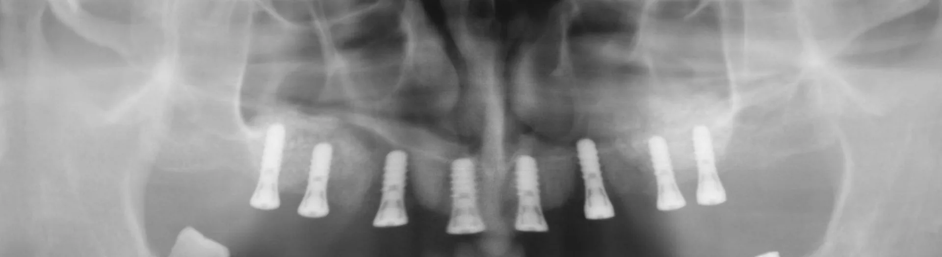 Panoramar&ouml;ntgen Implantate Oberkiefer