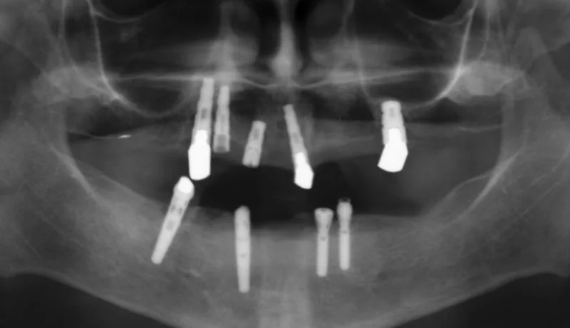 Fehlplatzierte Implantate