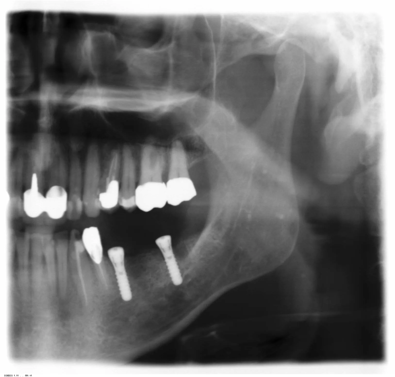 R&ouml;ntgenaufnahme Freiendl&uuml;cke mit zwei Implantaten