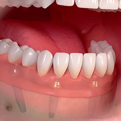 Sofortversorgung auf 4 Implantaten