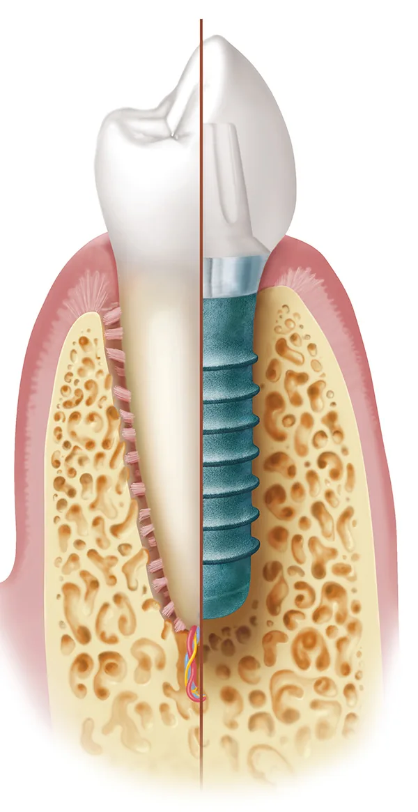 Vergleich Zahnwurzel und Implantat